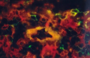 Dr Dinah Parums. A combined immunohistochemistry and immunofluorescence method showing CD31 positive endothelial cells (green) and HLA-DR positive cells (red) with 'activated' endothelial cells yellow.